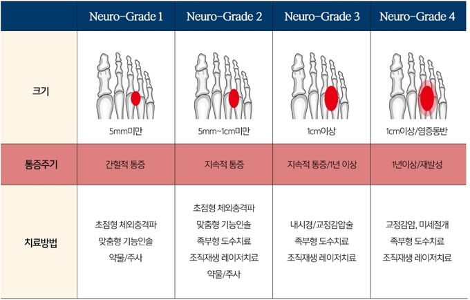 지간신경종 발가락 통증부위, 원인, 치료방법 3