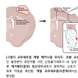 교모세포종 재발 원인 규명, 수술 후 재발 등 치료 어려운 악성 뇌종양...새 치료법 열리나