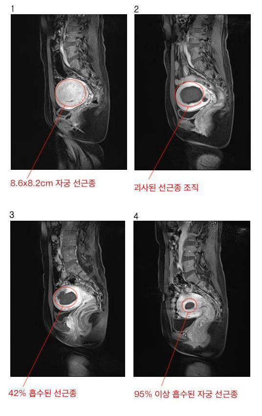 인천자궁선근증의 치료와 임신가능성이 궁금합니다.